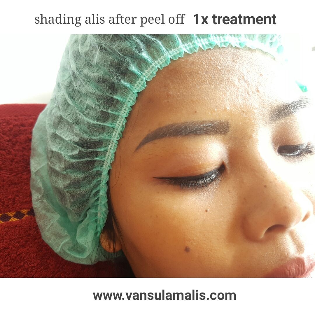 Hasil Shading Alis Setelah Peel Treatment 1 Kali