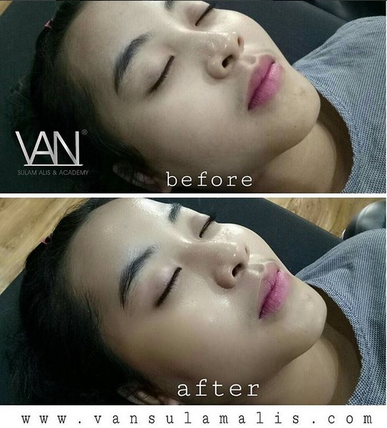 1x Treatment BB Glow di Surabaya Barat 19 Maret 2017