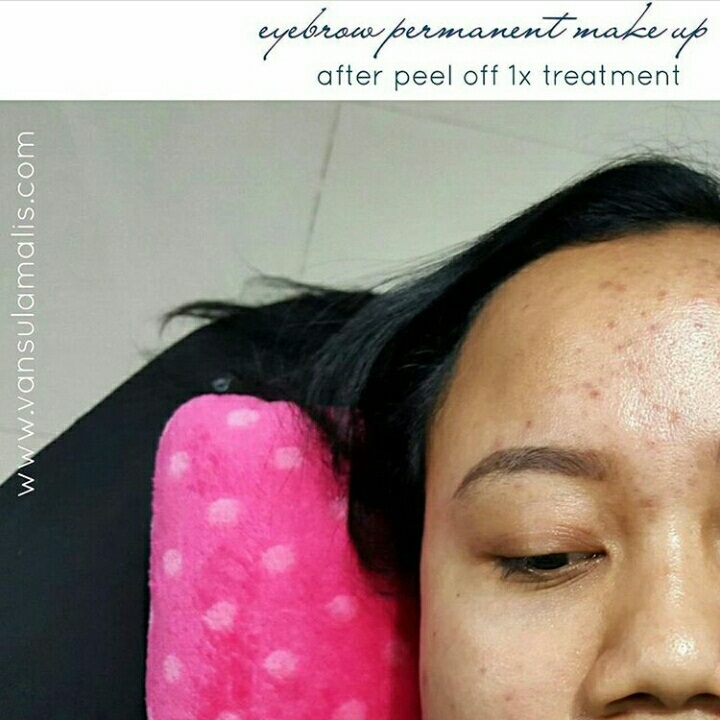 After Peel Off 1x Treatment Shading Alis 12 Juli 2016