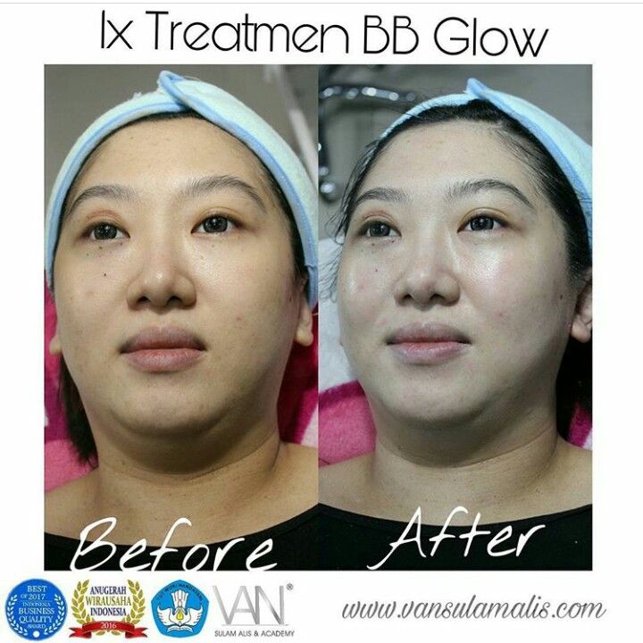 1x Treatment BB Glow di Surabaya Timur