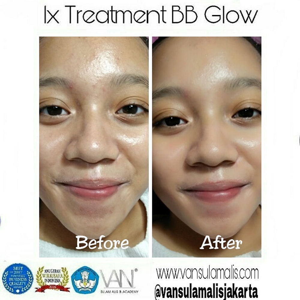 Hasil 1x Treatment BB Glow di Kemang
