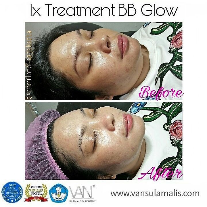 Hasil 1x Treatment di Kemang 19 Mei 2017