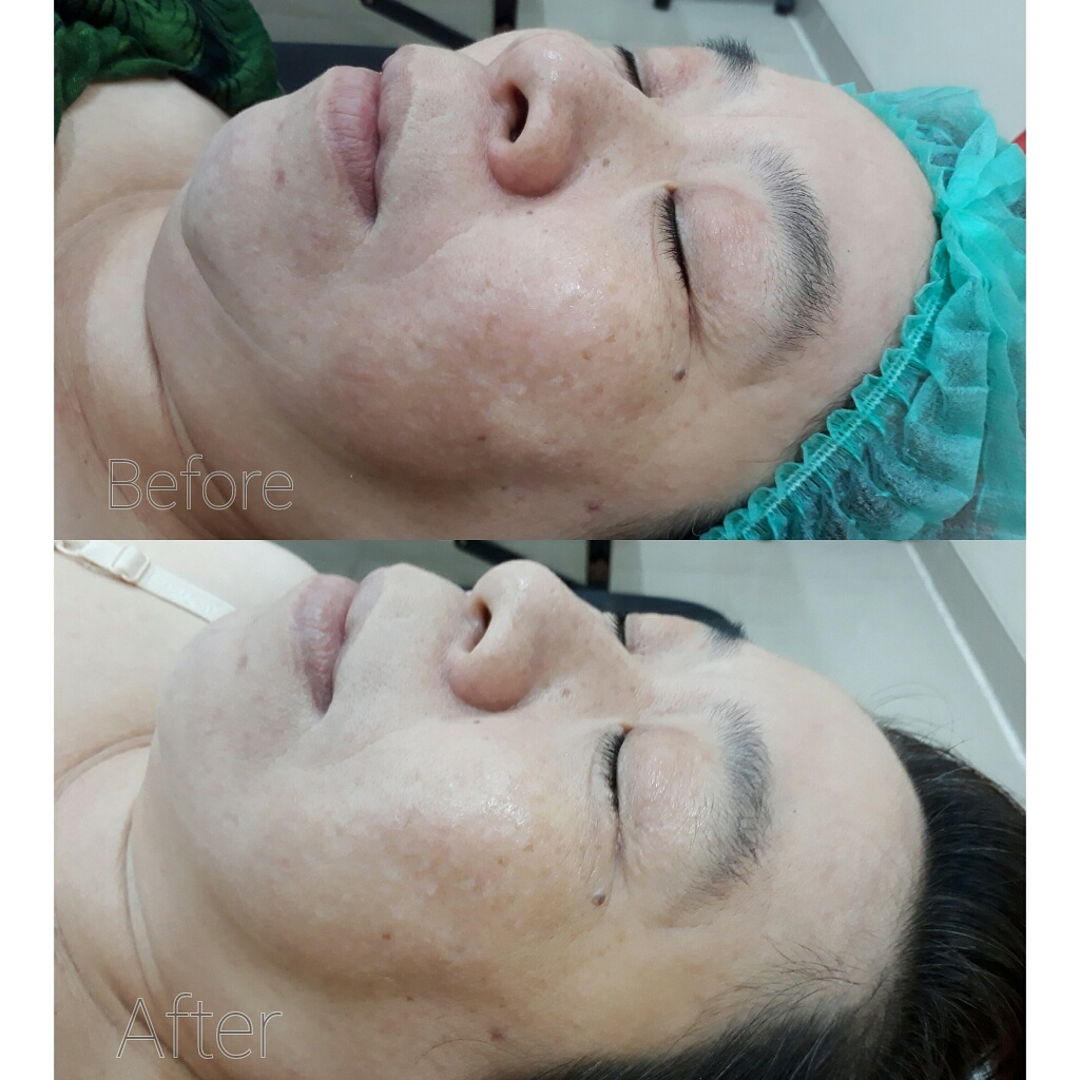 Hasil 1x Treatment BB Glow di PIK Jakarta Utara