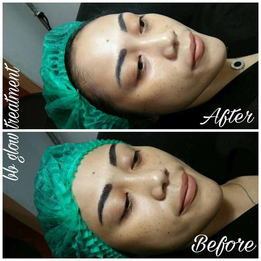 BB Glow 1x Treatment di Kemang