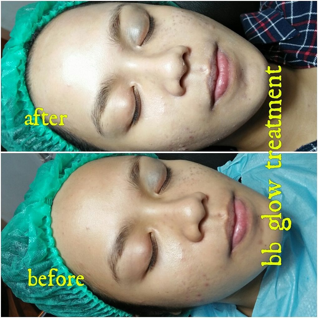 BB Glow 1x Treatment