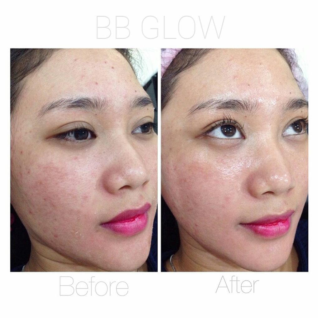 Hasil 1x Treatment BB Glow di Serpong
