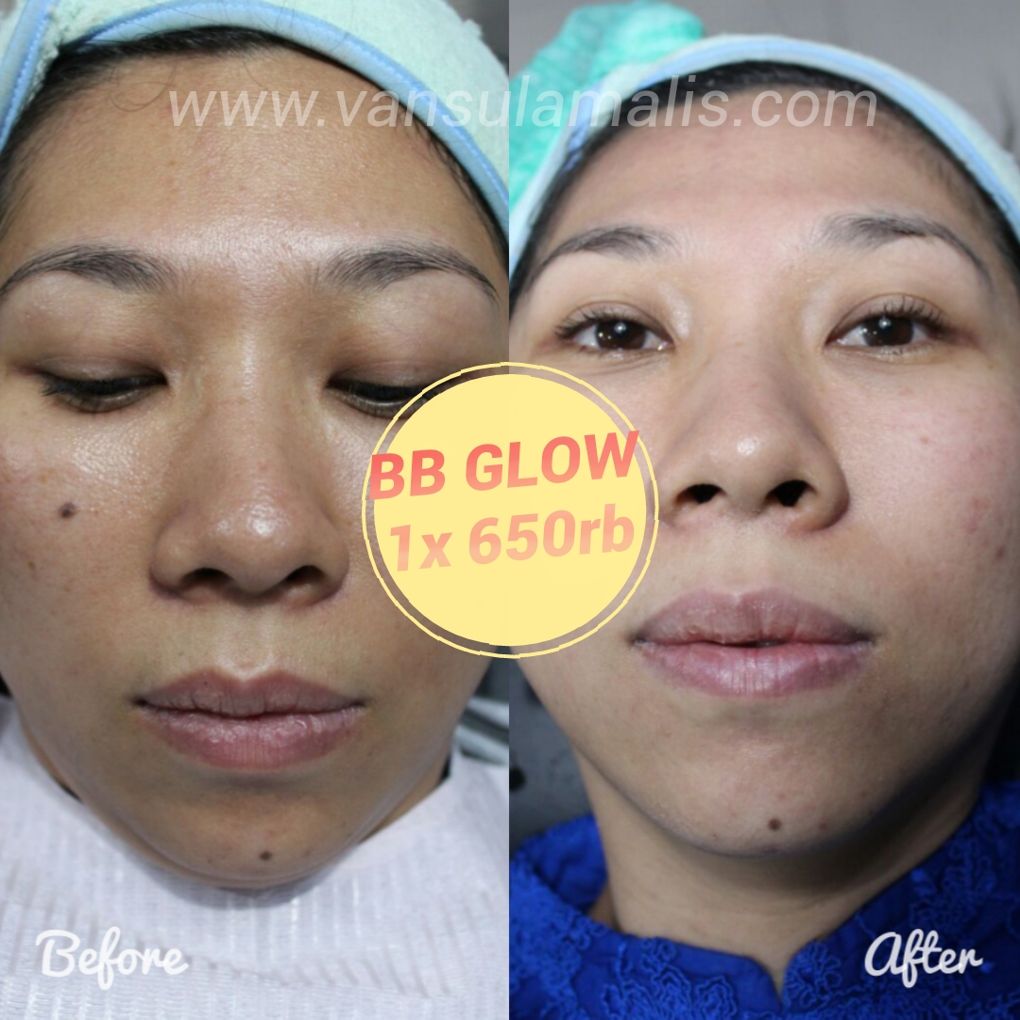 Hasil BB Glow 1x Treatment