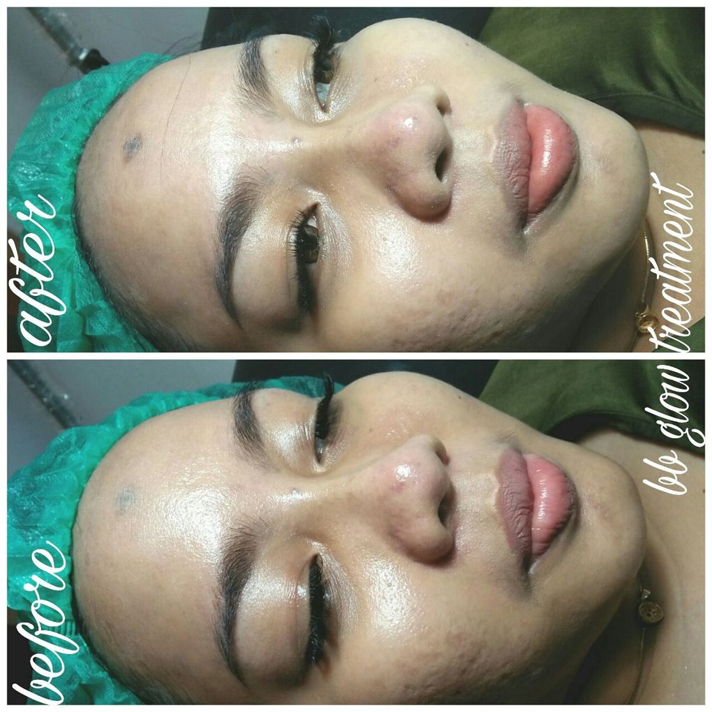 Hasil Sulam BB Glow 1x Treatment
