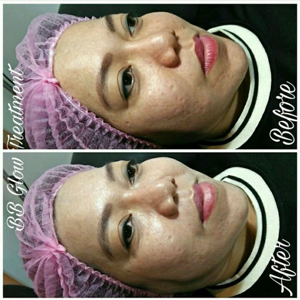 Sulam BB Glow 1x Treatment di Kemang Jakarta Selatan