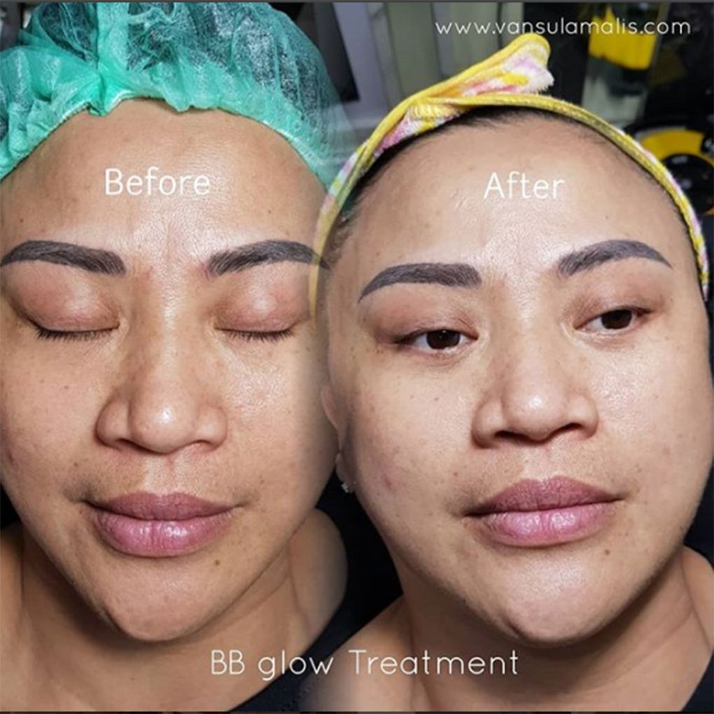 BB Glow 1x Treatment di Pik Jakarta Utara