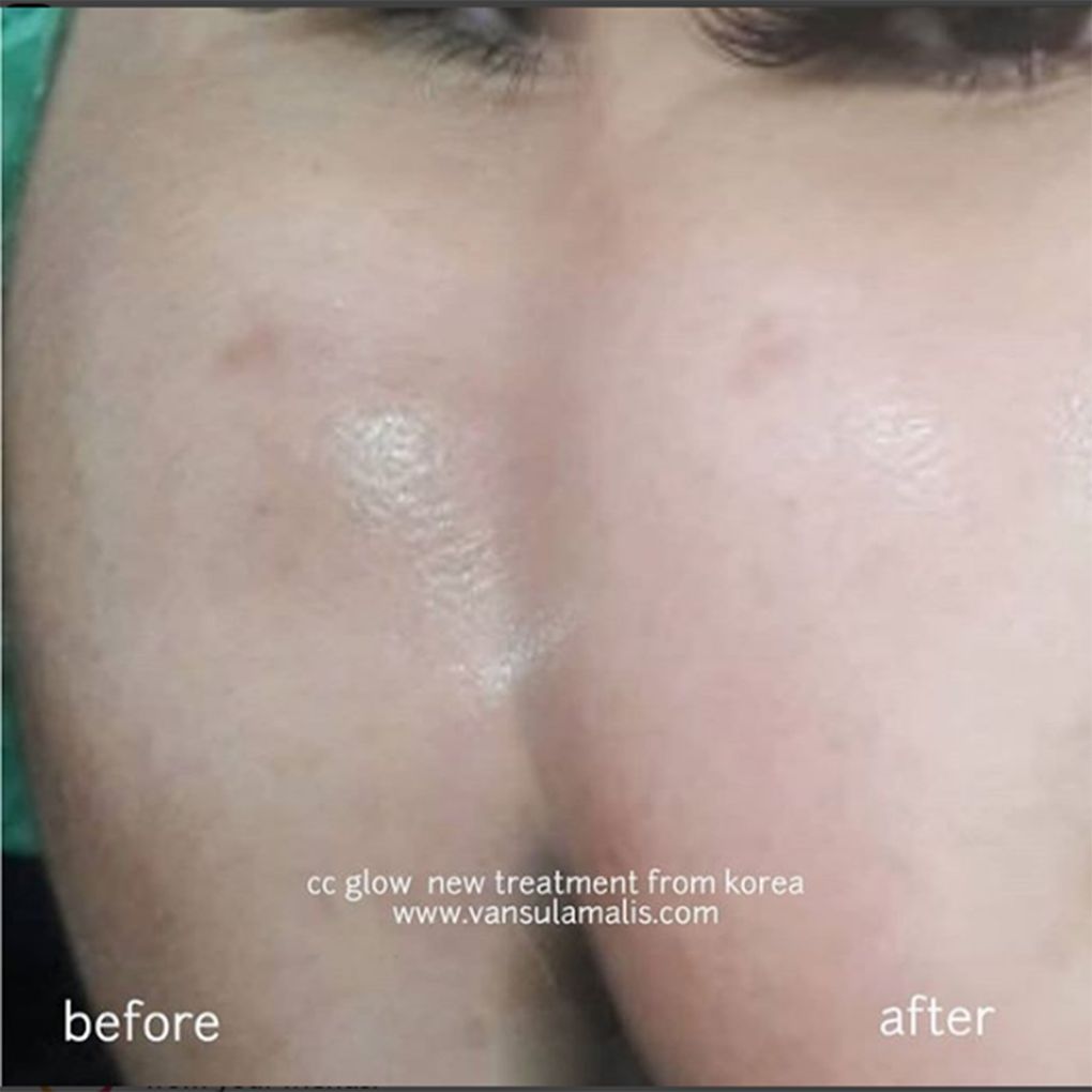 Hasil CC Glow 1x treatment