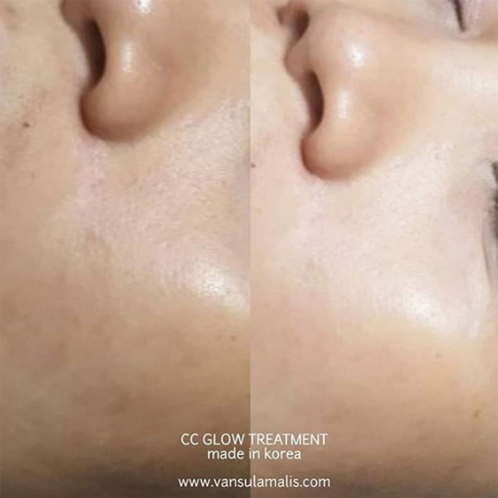 Hasil CC Glow di Pik Jakarta Utara