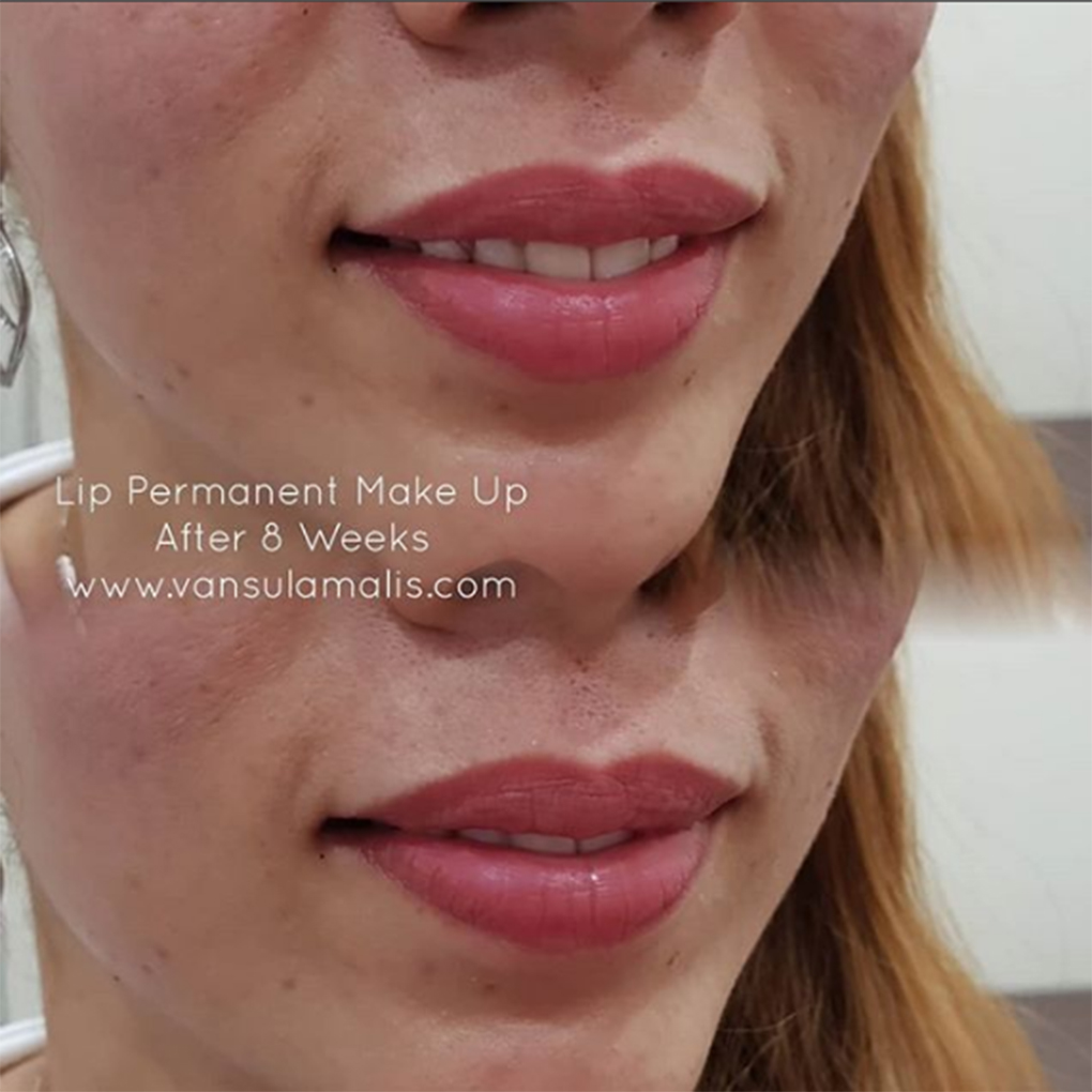 Hasil Sulam Bibir 1x Kerja di Pik Jakarta Utara