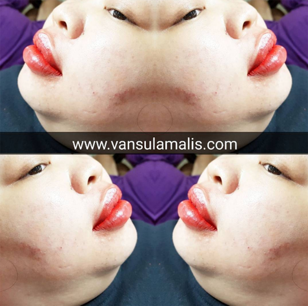 Sulam Bibir di Jakarta Utara