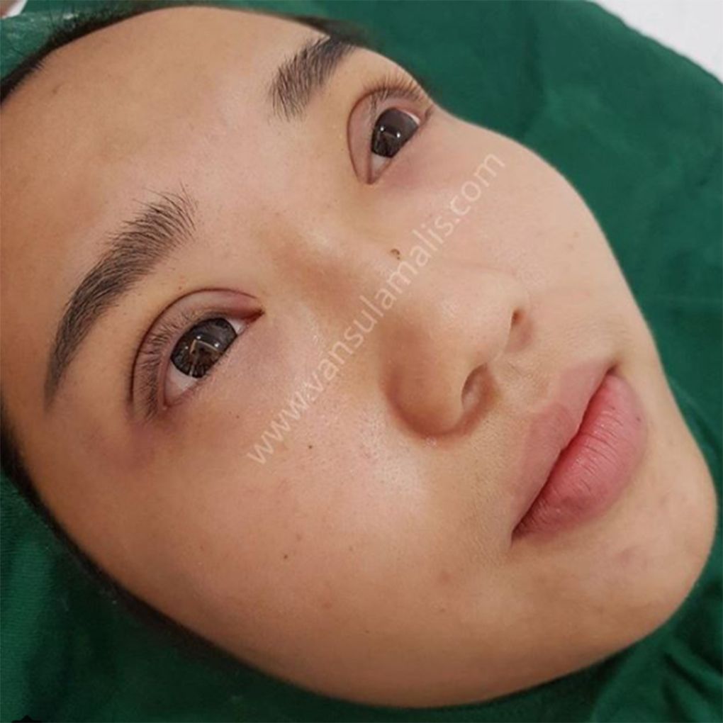 Sulam Lipatan Mata DOUBLE EYELID No Surgery!!