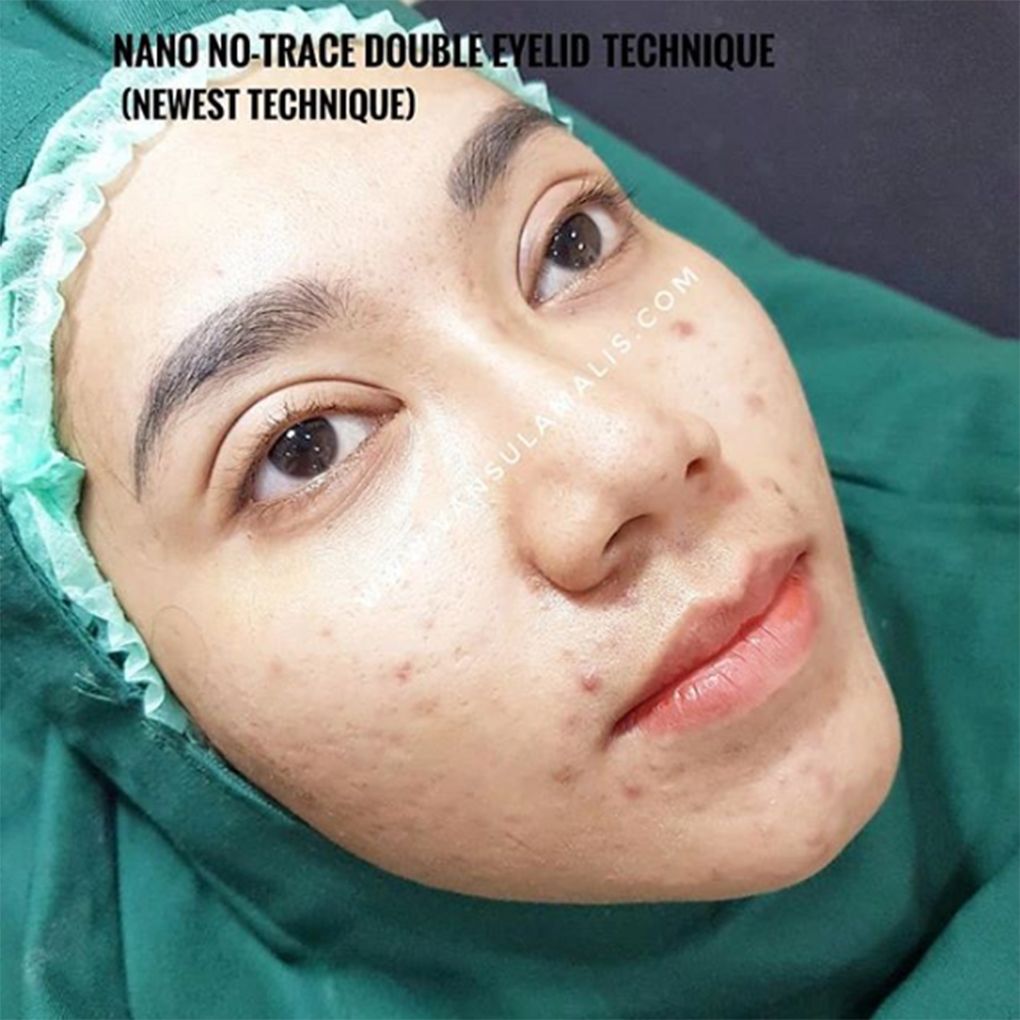 Sulam Lipatan Mata baru jadi (Tanpa Operasi)