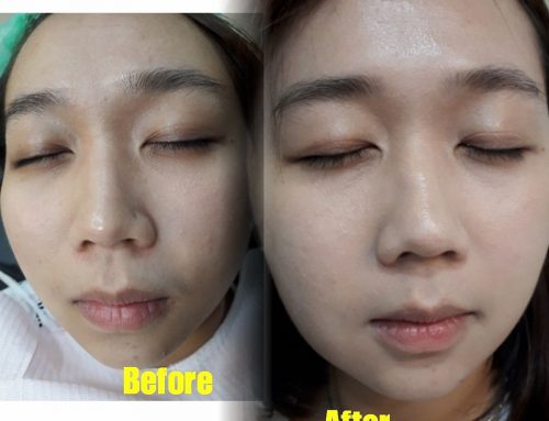 Hasil 1x Treatment BB Glow di Mangga Dua