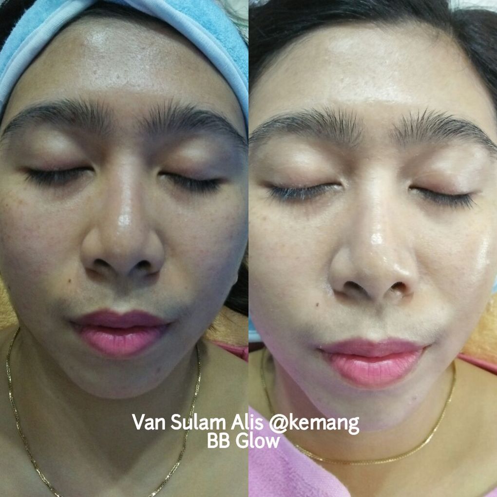 Hasil BB Glow 1x Treatment