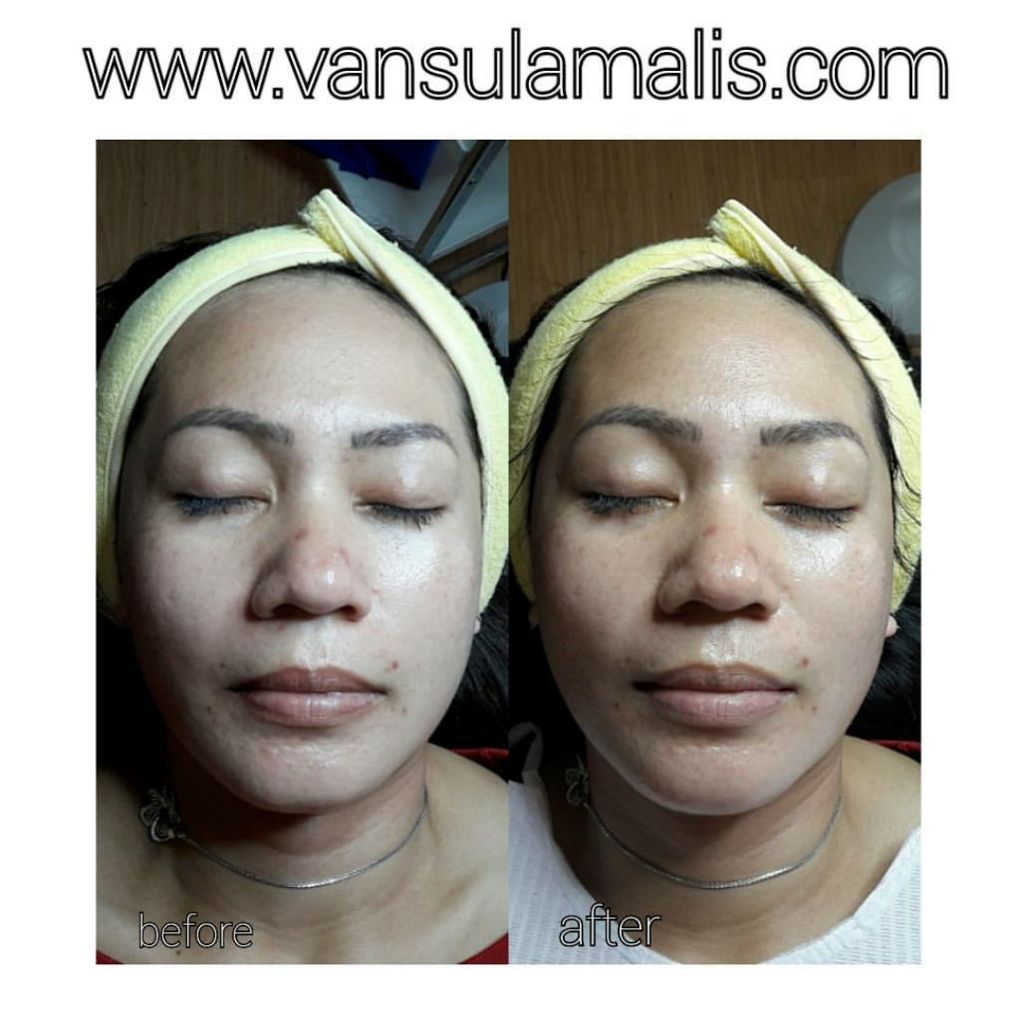 Hasil BB Glow 1x Treatment