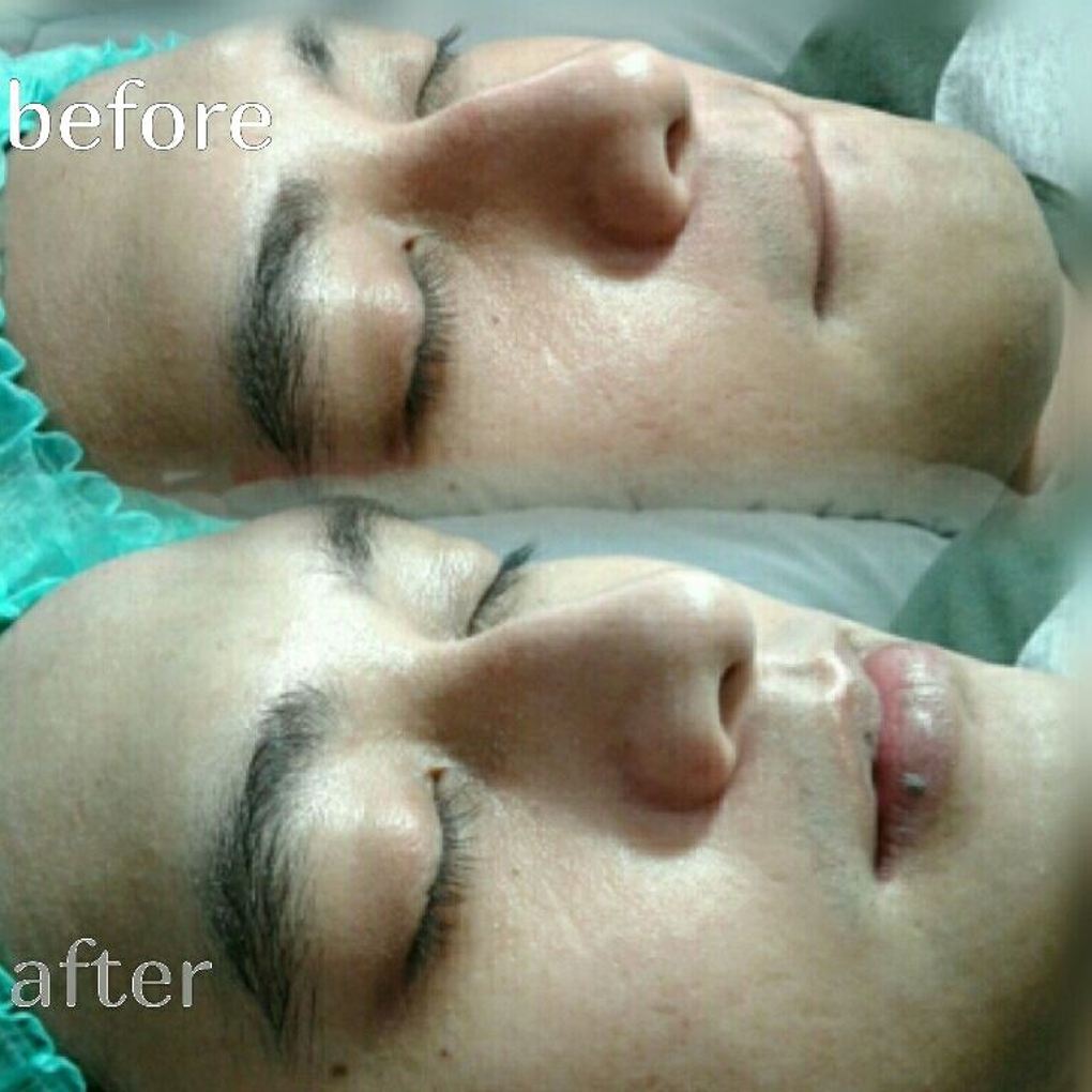 Hasil CC Glow 1x Treatment