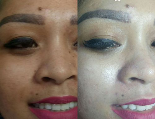 Hasil Treatment BB Glow 1x Treatment