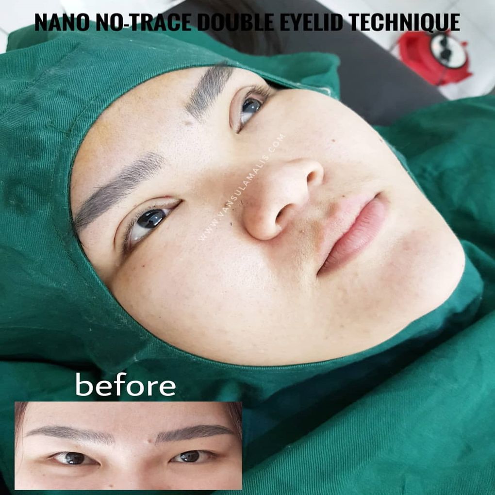 Setelah treatment double eyelid 5.