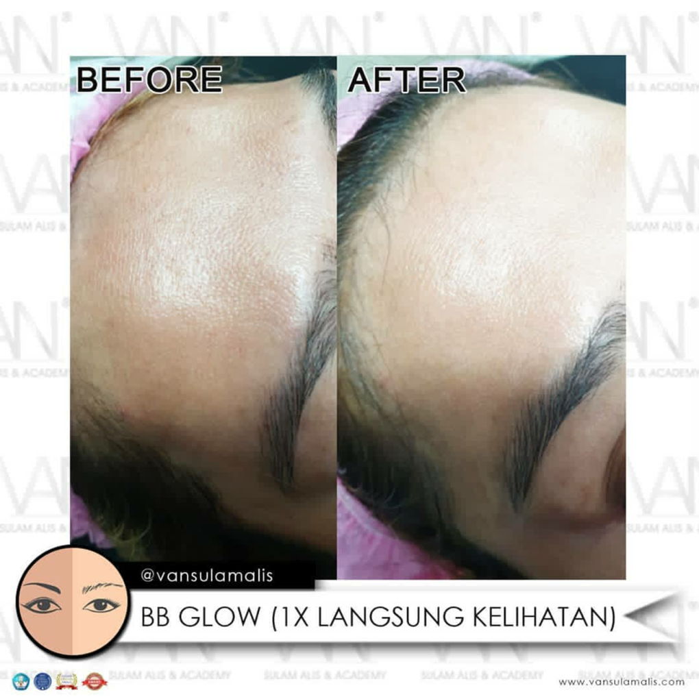 BEFORE AFTER BB GLOW 1X TREATMENT
